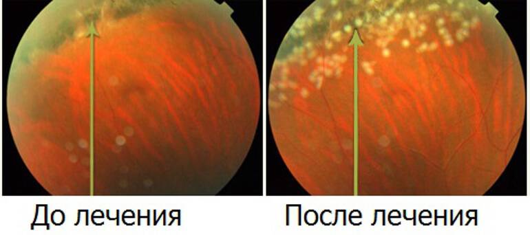 Причины абиотрофии сетчатки глаза у детей и взрослых – диагностика и лечение патологии