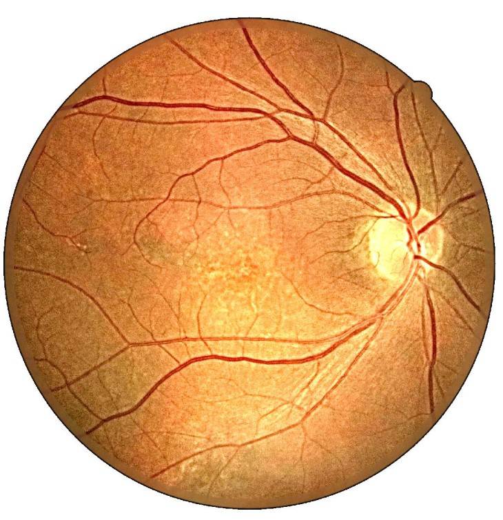 Возрастная макулодистрофия - влажная форма заболевания глаза, современные способы лечения, причины и прогноз сохранения зрения