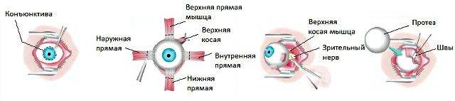 Энуклеация глаза