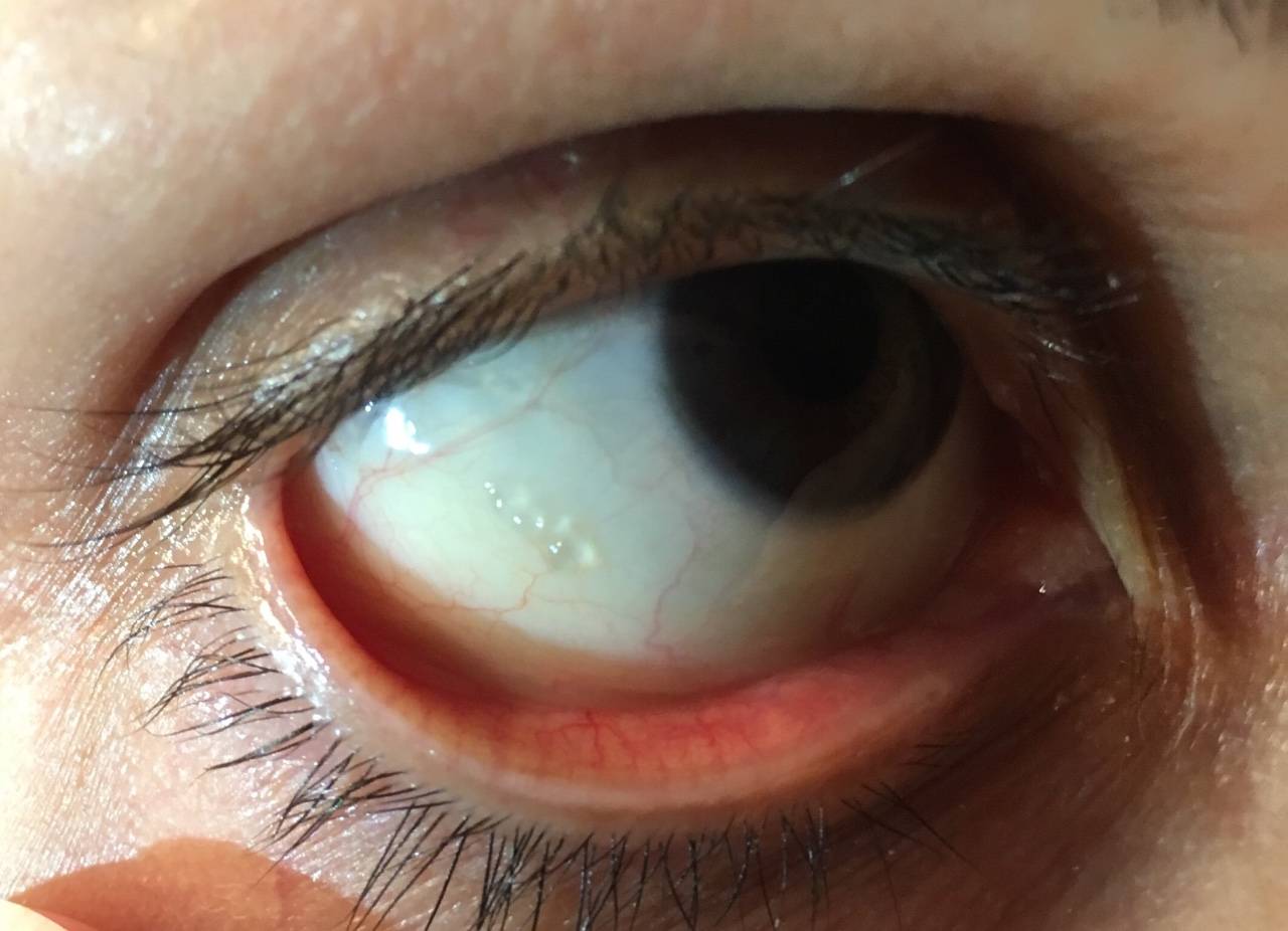 Киста конъюнктивы: фото глаза при заболевании и методы лечения