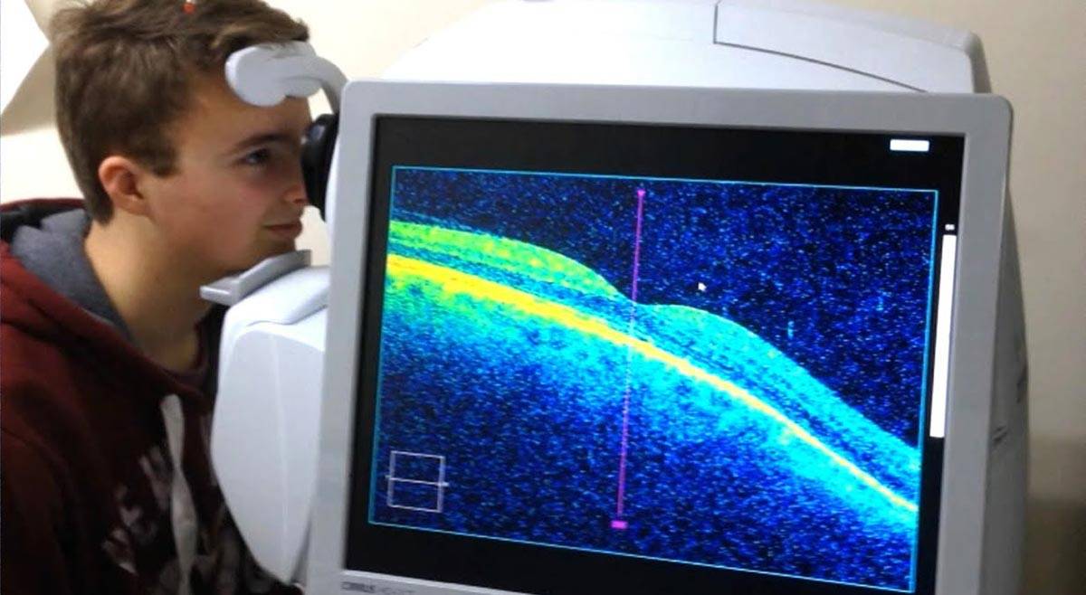 Оптическая когерентная томография (окт) при глаукоме