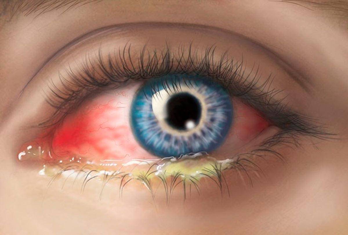 Гнойный конъюнктивит: симптомы и лечение - "здоровое око"