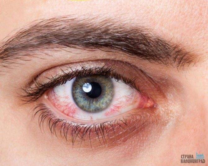Красные глаза и насморк у ребенка - причины, лечение