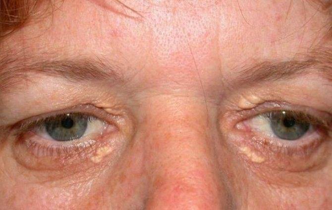 Под глазами желтые пятна, круги: причины появления (на веках, вокруг глаз), симптомы, лечение, препараты, фото