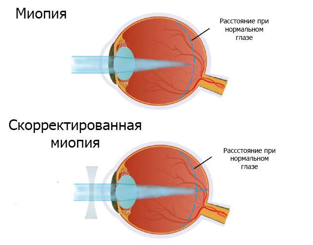 Близорукость — это не приговор: методы коррекции зрения