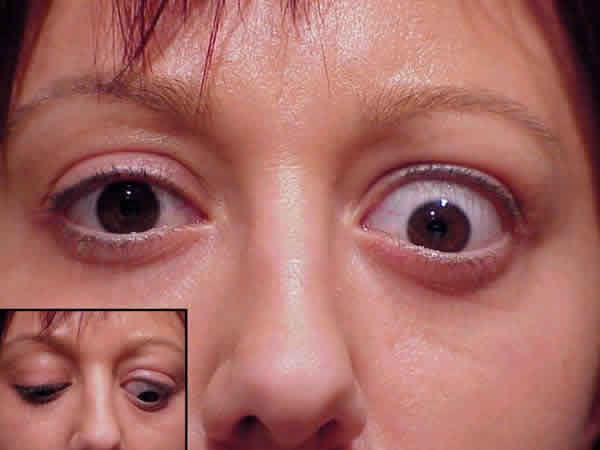 Болезнь выпученных глаз