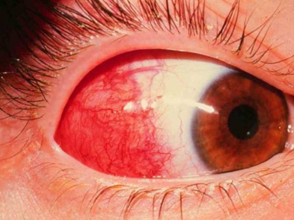 Эписклерит глаза: причины заболевания у взрослых, лечение