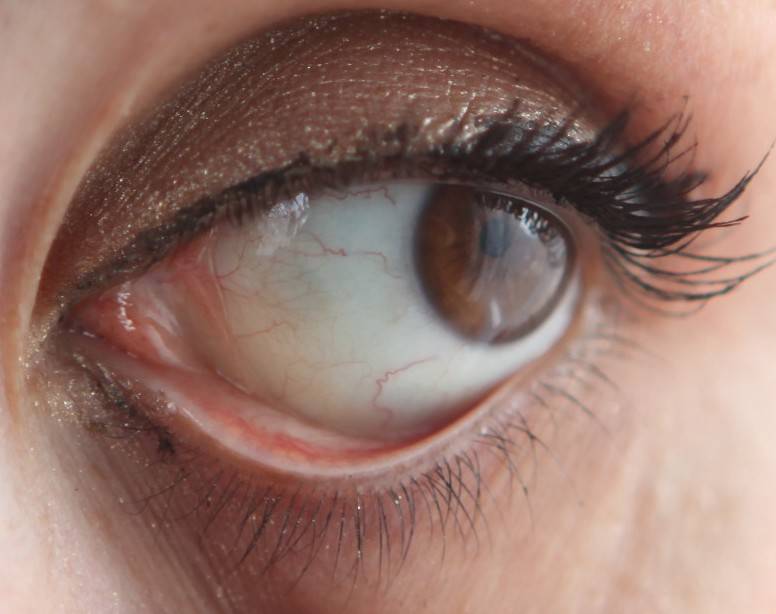 Жёлтые пятна на белке глаза: причины и симптомы - "здоровое око"