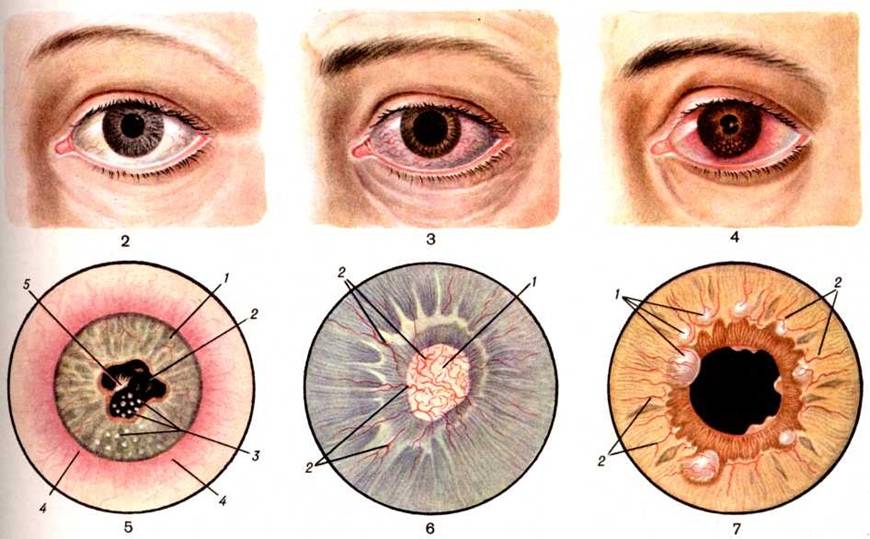 Иридоциклит глаза:симпотомы - "здоровое око"