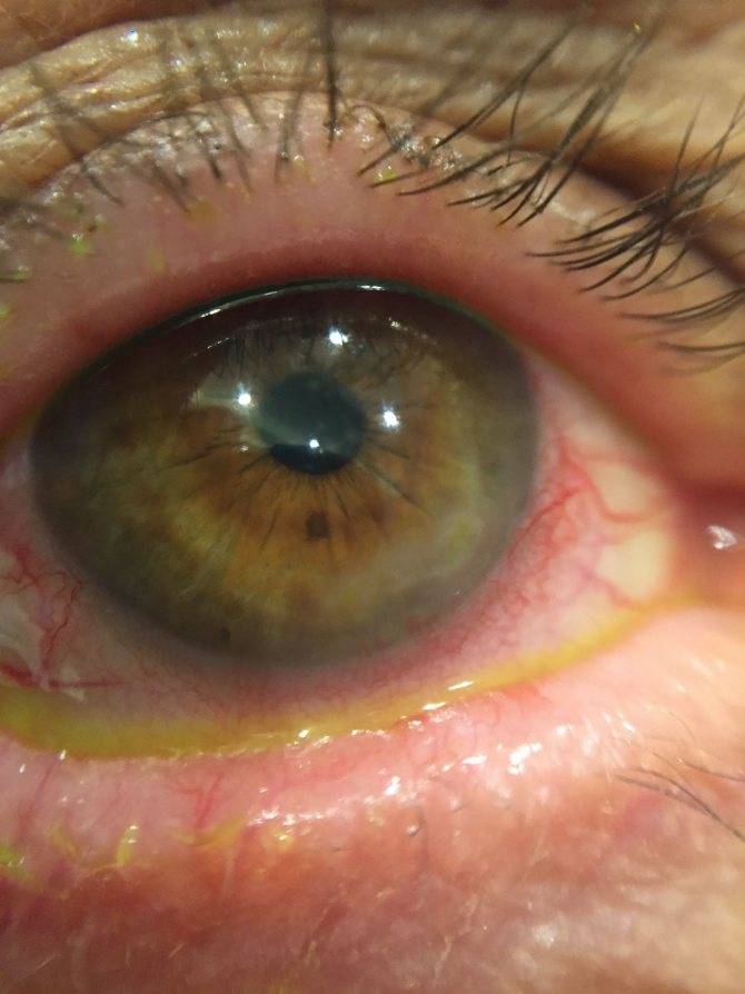Воспаление роговицы глаза