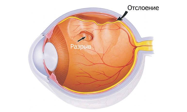 Отслоение сетчатки глаза: что это, признаки, лечение и операция