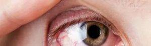Боль в глазу при движении глазного яблока