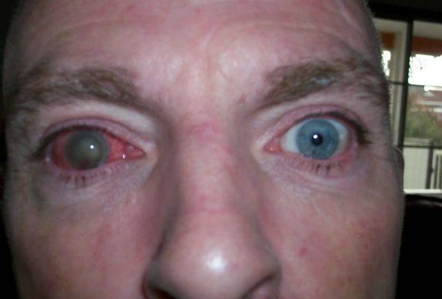 Травма глаза - первая помощь, последствия, лечение в домашних условиях