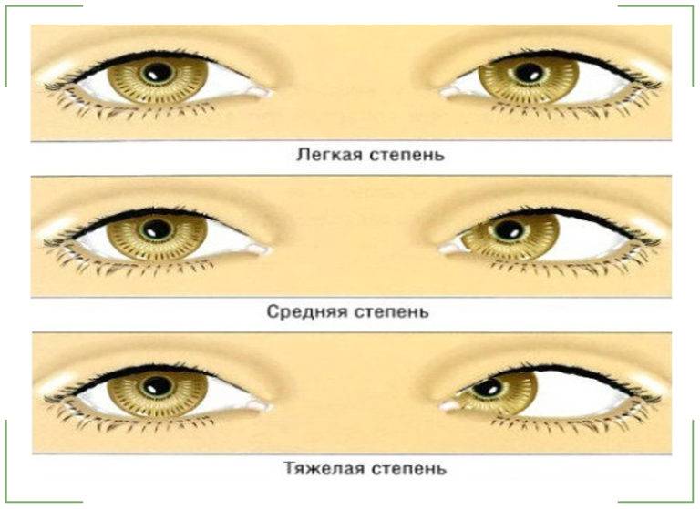 Амблиопия глаза с пометкой од: что это такое, почему поражает один зрительный орган, правый или левый