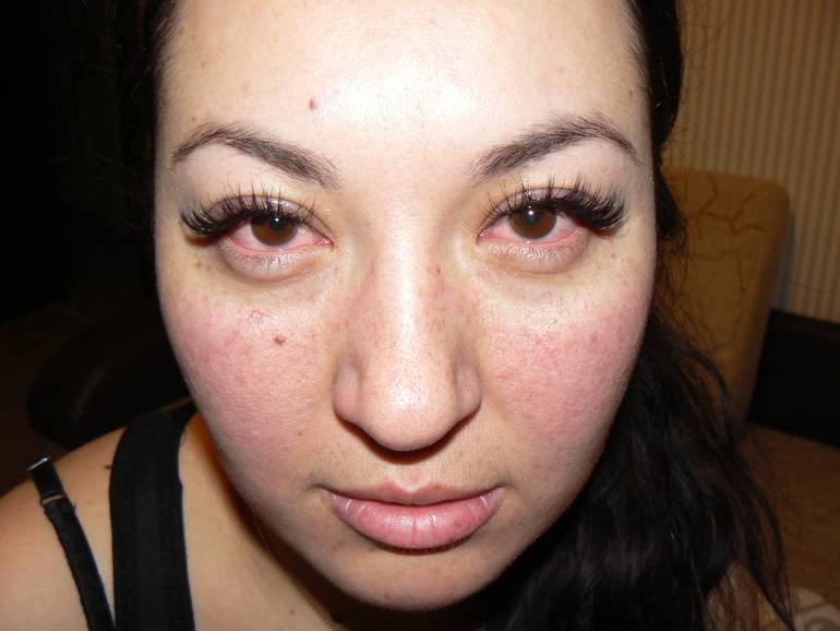 Аллергия на глазах - как лечить на веках от косметики
