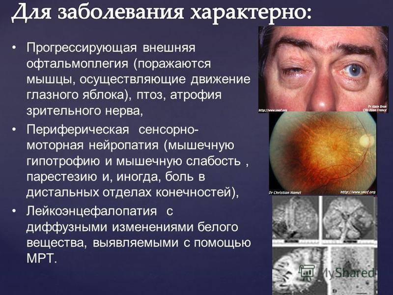Микрофтальм глаза: лечение, причины, симптомы, диагностика и осложнения