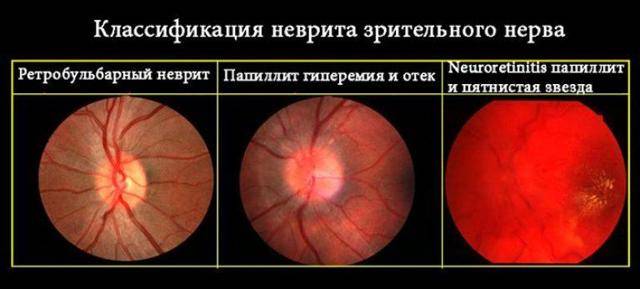 Ретробульбарный неврит: как лечить - "здоровое око"