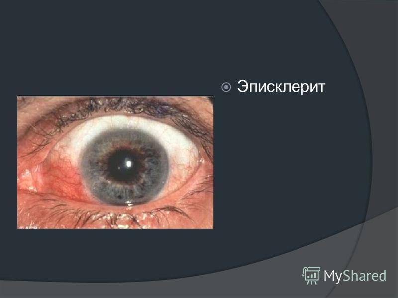 Эписклерит левого и правого глаза: что это такое, простой и узелковый вид, диагностика, лечение, фото при заболевании