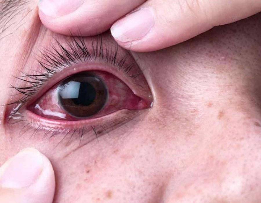 Красные глаза от компьютера: что делать, какие препараты закапать