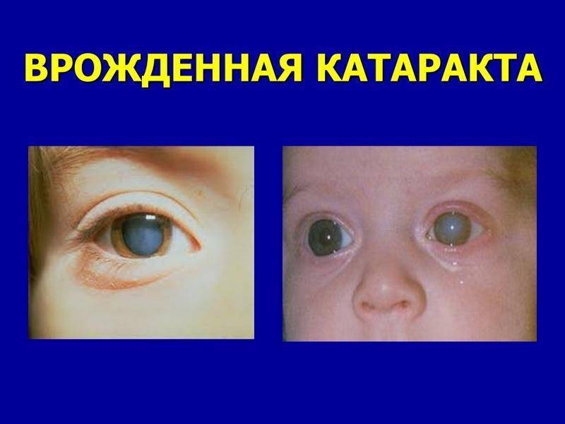 Врождённая или приобретённая катаракта у ребёнка