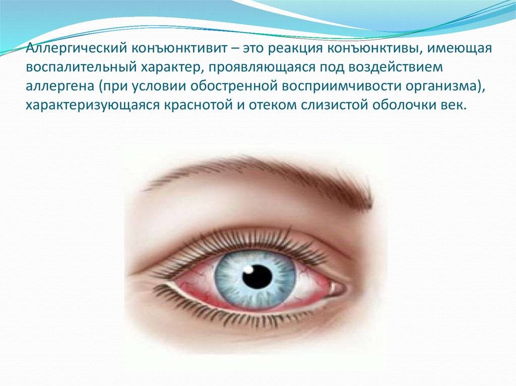 Глазной конъюнктивит лечение