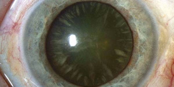 Особенности ядерной катаракты: стадии развития и лечение