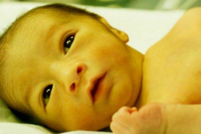 Желтые белки глаз у новорожденных: лечение (фото)