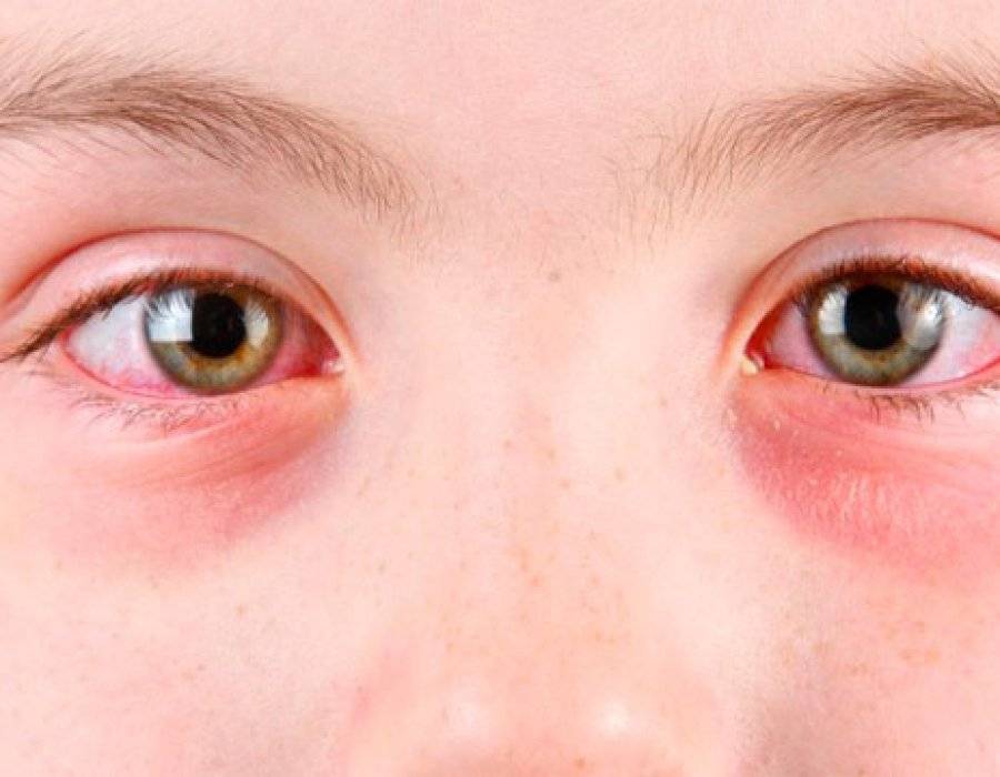 Красные круги под глазами у ребенка – причины и лечение!