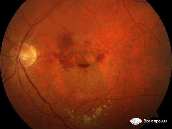 Кровоизлияние в стекловидное тело глаза - причины и лечение
