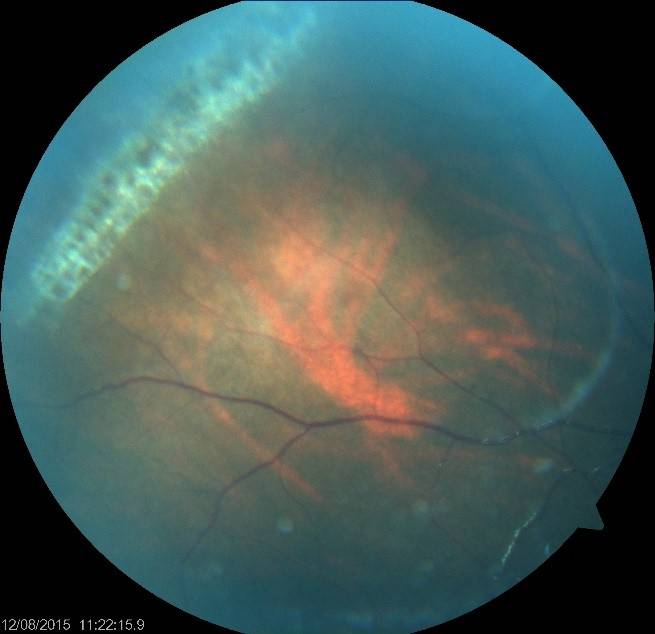 Диагноз - пхрд сетчатки глаза: что это такое, причины и степени