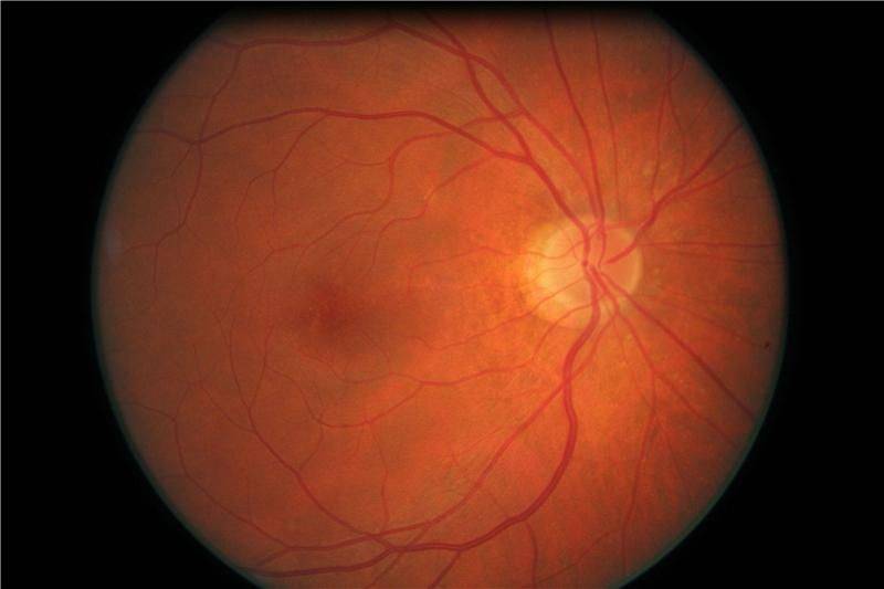 Макулярный отек сетчатки глаза: симптомы, причины и лечение