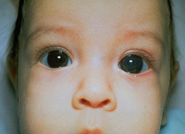 Глаукома у детей: симптомы, причины, лечение, операция, диагностика, профилактика ювенильной формы и у новорожденных