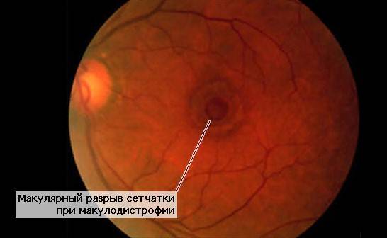 Разрыв сетчатки глаза: симптомы, причины, операция и последствия