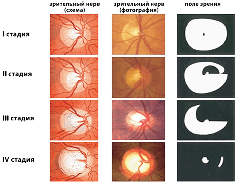 Открытоугольная глаукома картинки