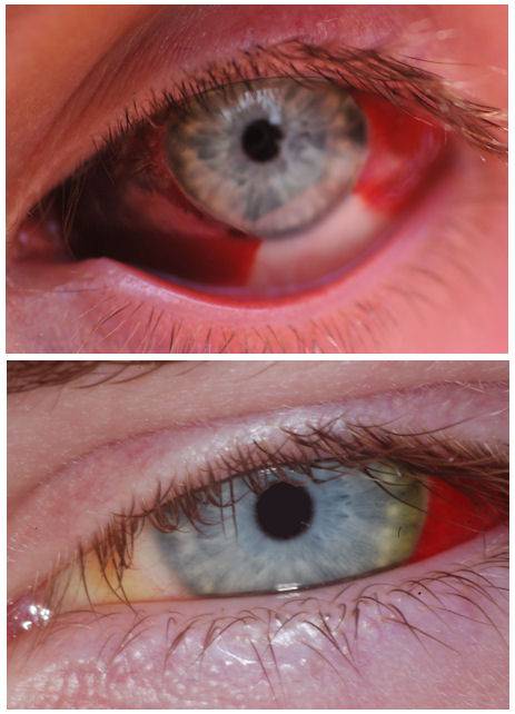 Кровоизлияние в глаз - причины, фото, что делать