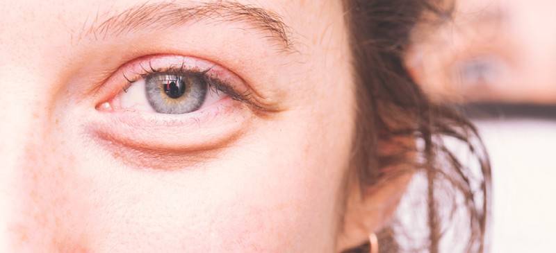 Причины красных глаз сразу после сна