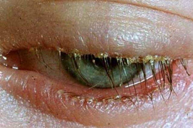 Глазной клещ (демодекс) или ресничный клещ: симптомы и лечение