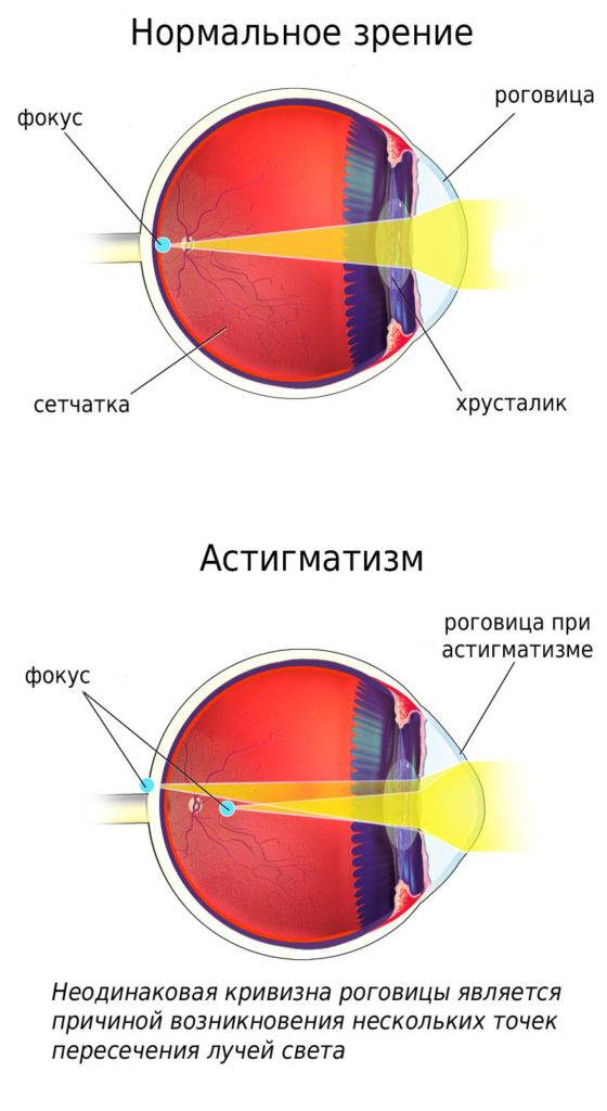 Сужение поля зрения - причины и лечение
