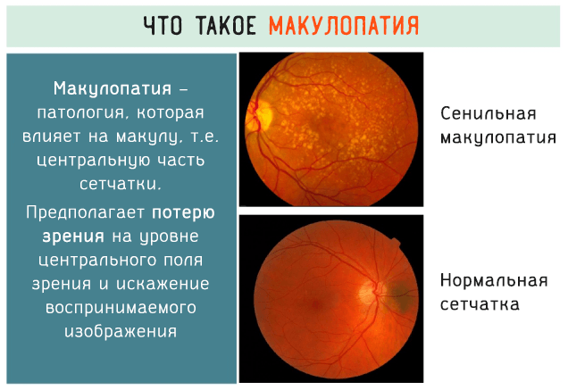 Макулодистрофия сетчатки глаза (макулярная дегенерация)