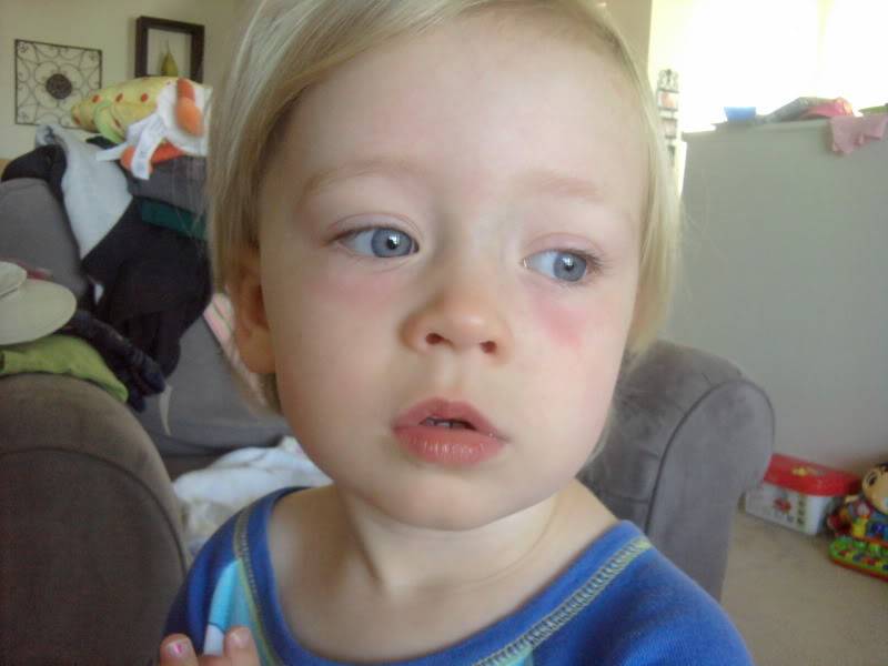 Как можно убрать синяки под глазами у ребенка?