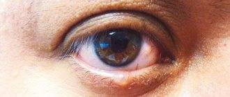 Бельмо на глазу человека: симптомы, причины, эффективное лечение