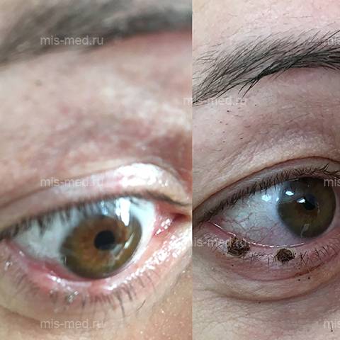 Витреолизис, избавляемся от мушек перед глазами без операции