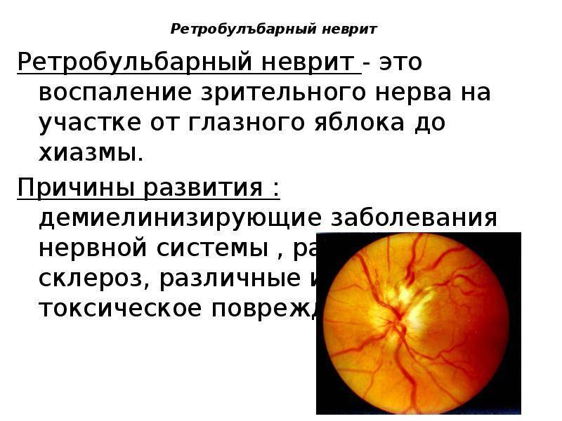 Атрофия зрительного нерва:  признаки, диагностика и лечение