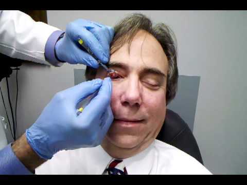 Что такое халязион на глазу и насколько он опасен: лечение, причины, симптомы