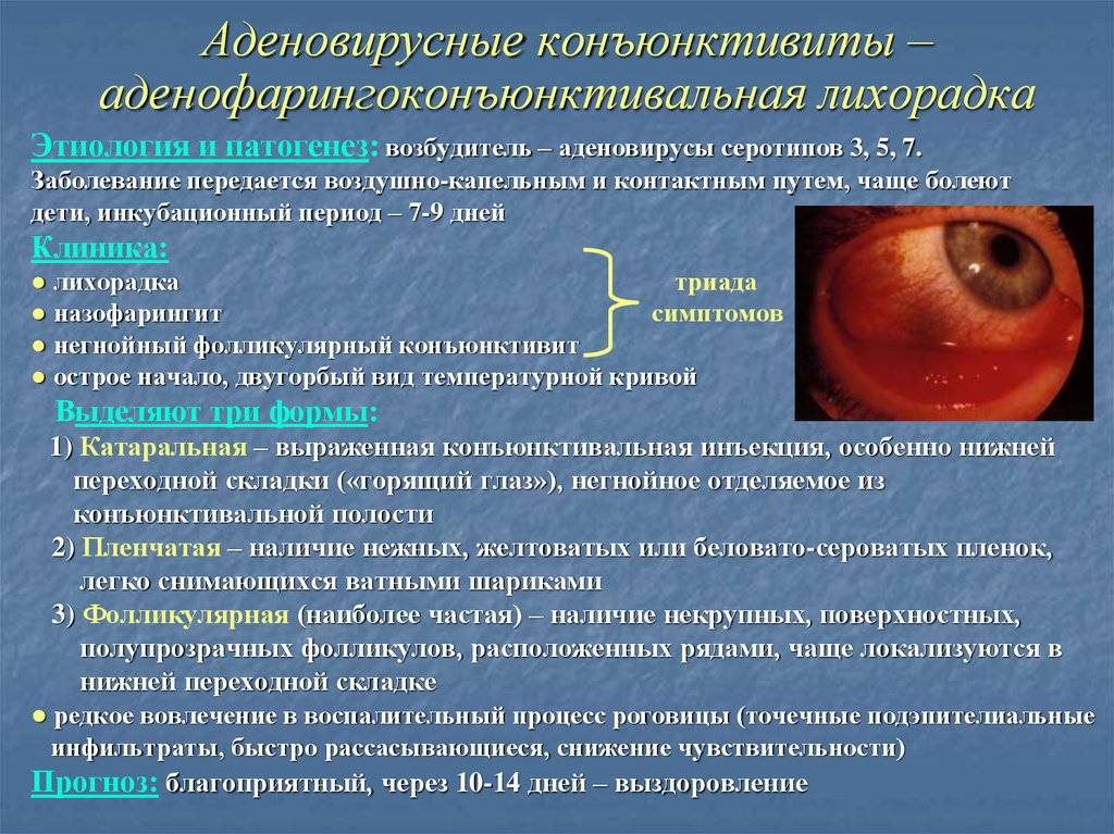 Бактериальный конъюнктивит: причины и лечение - "здоровое око"