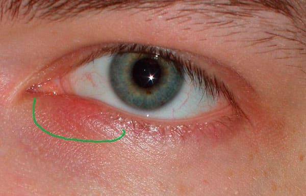Герпес глаза, симптомы у взрослых, как возникает, лечение