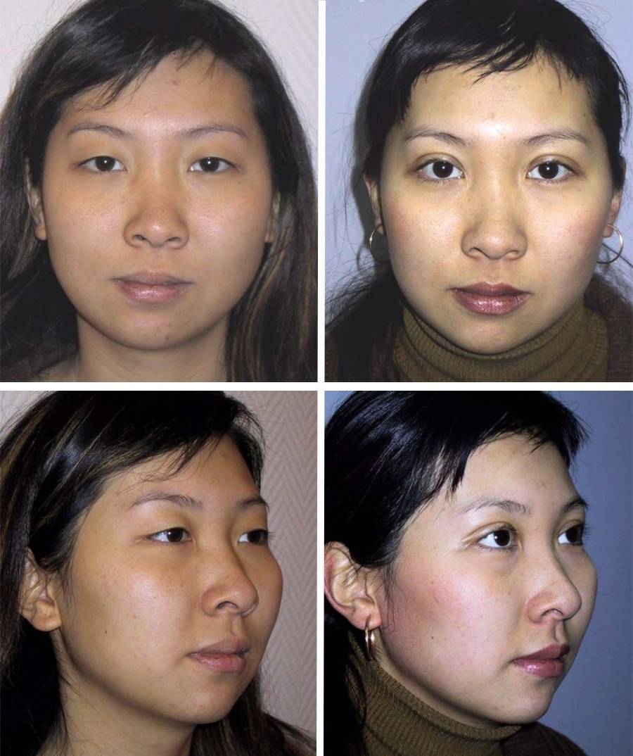 Кантопластика глаз: фото до и после, отзывы, стоимость операции. виды кантопластики глаз