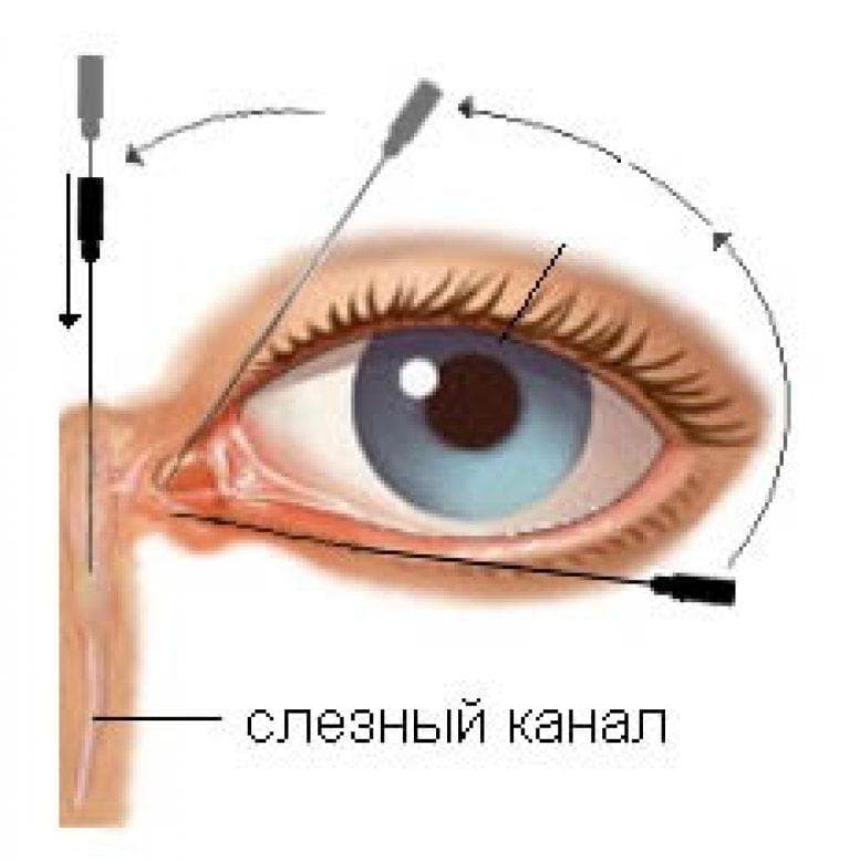 Зондирование глаз: показания к назначению бужирования слезного канала, риски процедуры, побочные эффекты