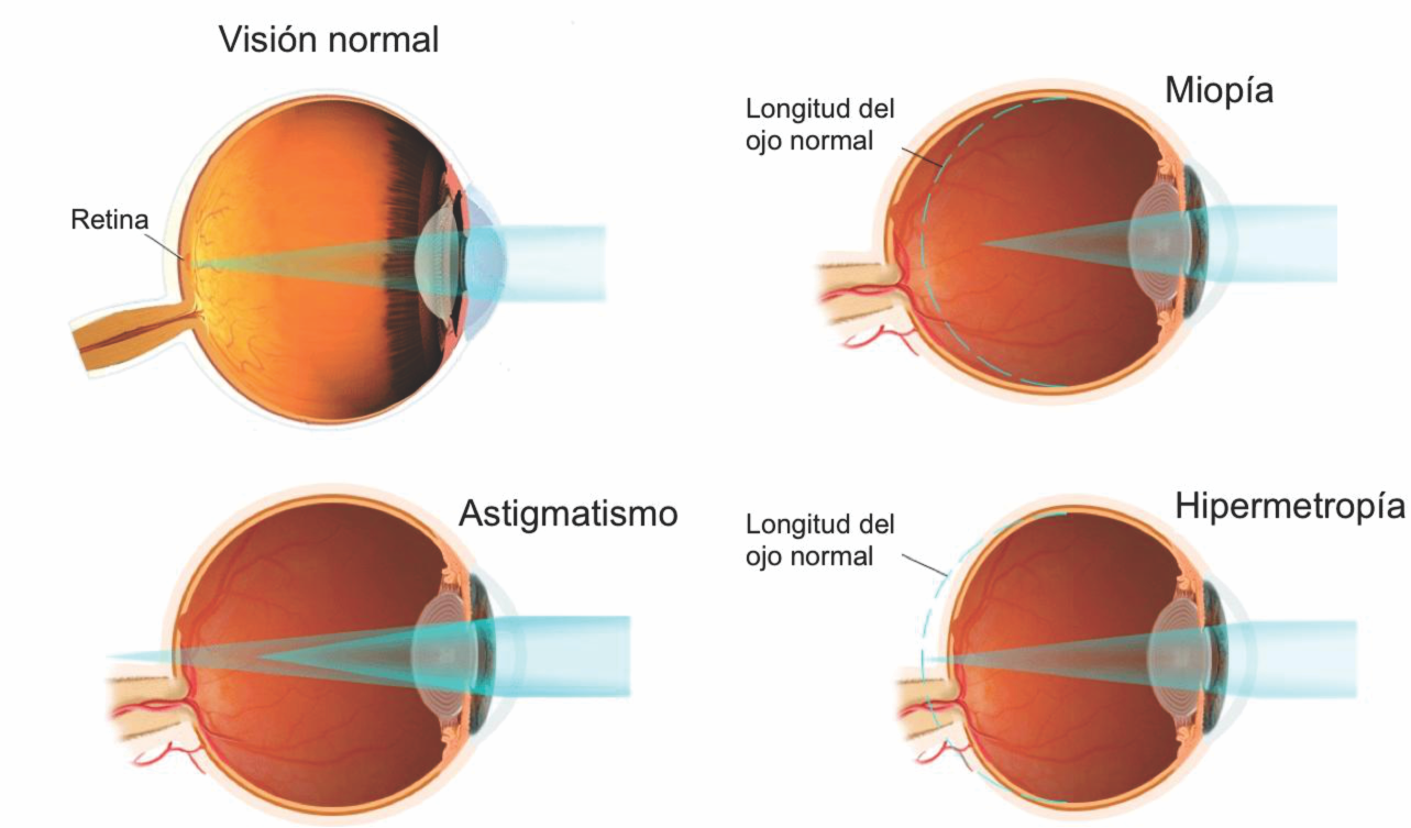 Миопия высокой степени: что это такое, лечение обоих глаз у взрослых, чем опасна прогрессирующая, освобождение при физкультуре при легкой