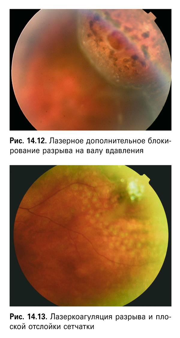 Лазерная коагуляция сетчатки | мнтк «микрохирургия глаза» им. акад. с.н. федорова